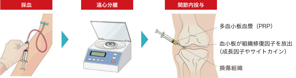 PRPの作成と投与方法