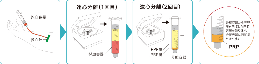 PRP療法の実施